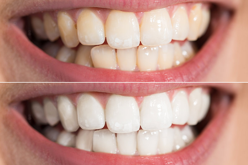 Professional Teeth Whitening Treatment - Toland Dental