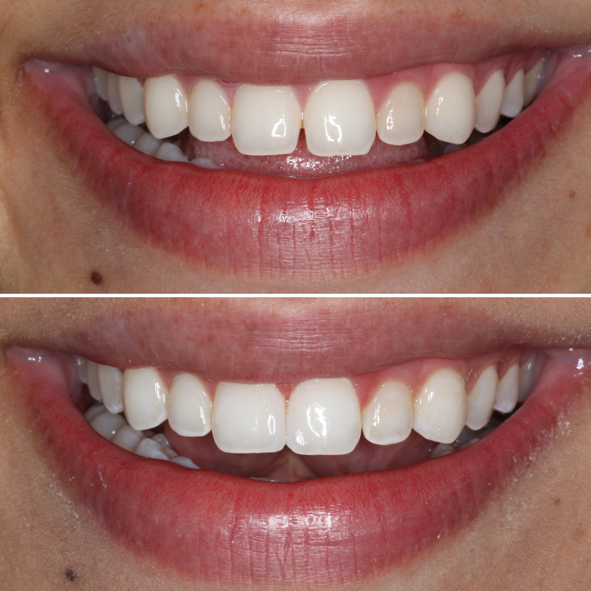 Natural-Looking Dental Crowns - Toland Dental Services