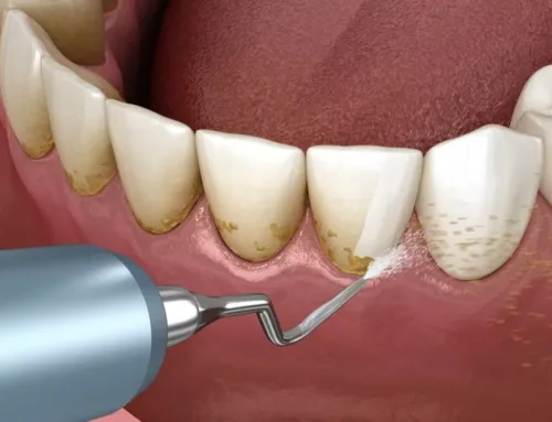 Why Does My Tooth Hurt? Common Causes of Tooth Pain Explained
