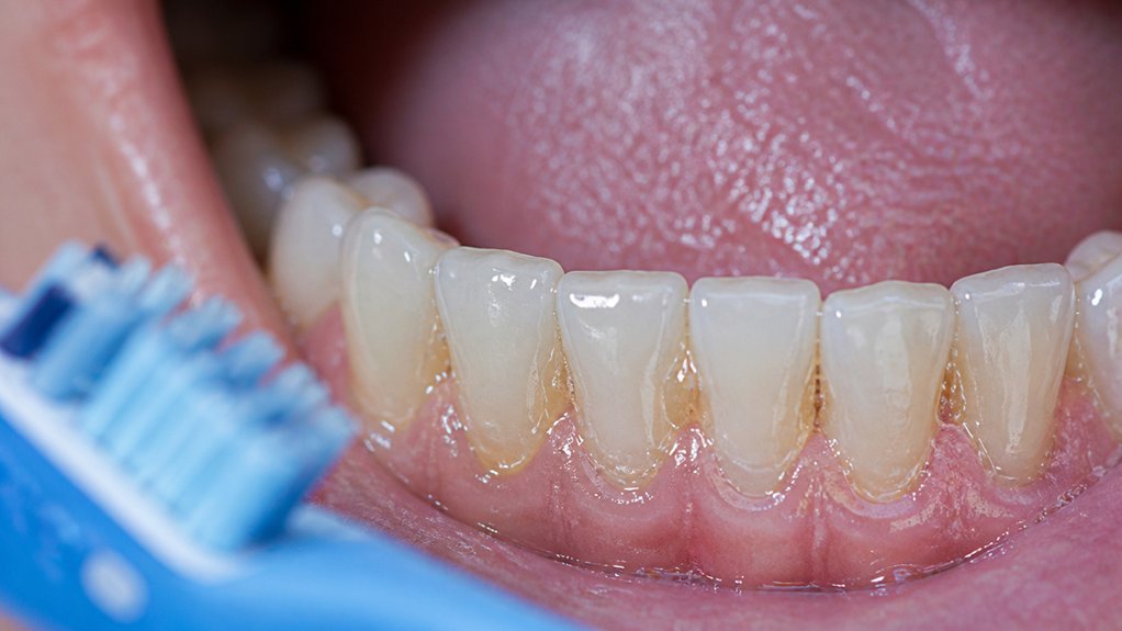 10 Signs You Need Your Teeth Cleaned Now plaque leads to gum disease