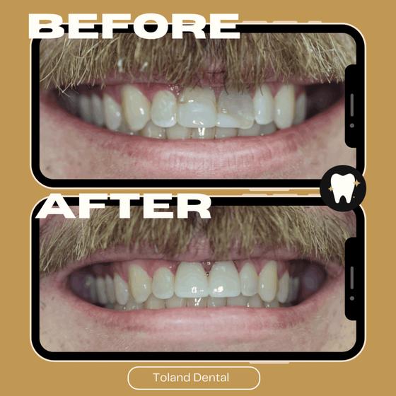 Home Before and after smile transformation — Toland Dental patient