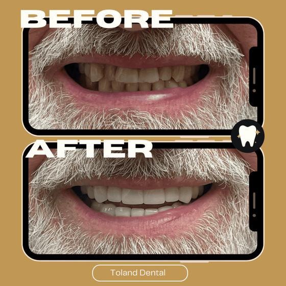 Home Before and after dental restoration — Toland Dental patient