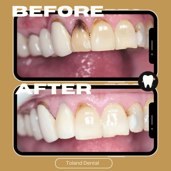 Home Before and after veneers — Toland Dental patient