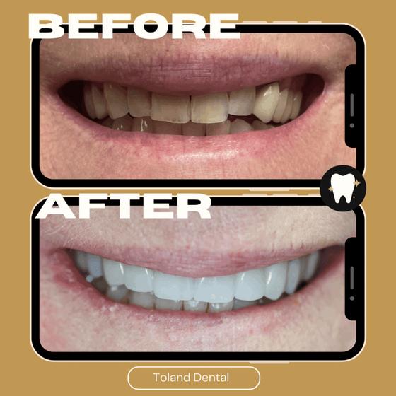 Home Before and after cosmetic work — Toland Dental patient