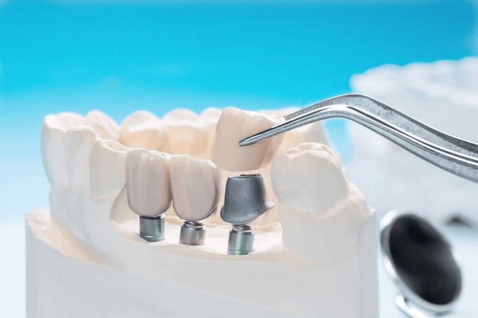 Home Dental implants in Melbourne FL